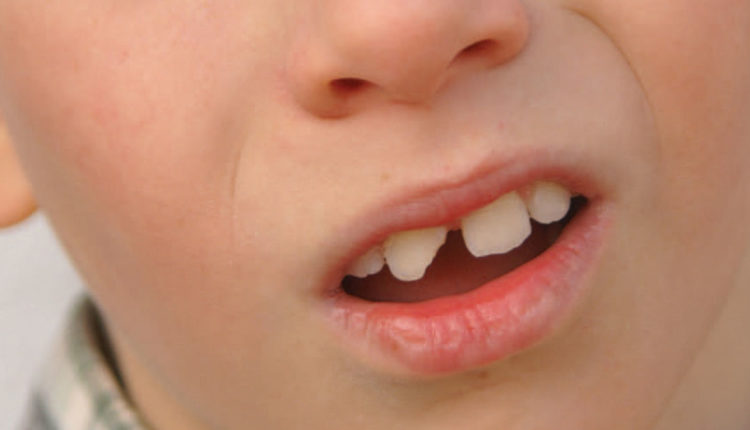 Handling Broken Front Teeth in Children: A Parent’s Guide